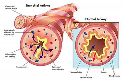detalles asma bronquial