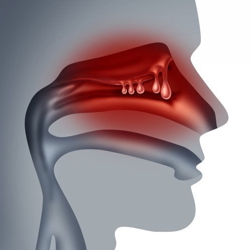 airalia humidificador sinusitis polipos nasales